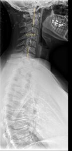 halswirbelsäule-spine-scan-before-treatment-vor-behandlung-cultureandcream-blogpost