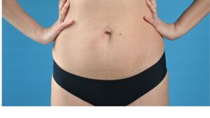 woman-frau-postnatal-bauch-belly-rektusdiastase-cultureandcream-blogpost