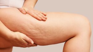 cellulite-slimming-elasticity-straffiung-body-cultureandcream-blogpost