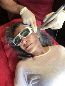 laser-treatment-outside-jawline-tightening-fotona4D-cultureandcream-blogpost